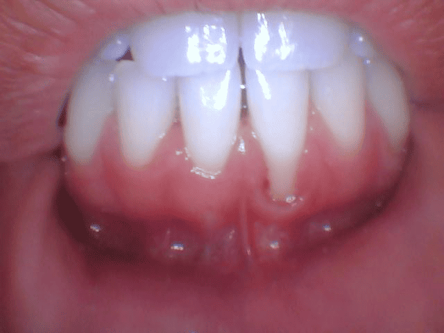 A close up of a person's mouth with white teeth showcasing bridges and crowns.