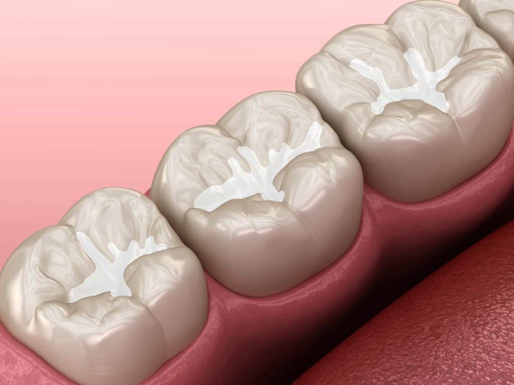 Digital illustration shows molar teeth with tooth-colored dental sealants. The surface of the teeth is covered by sealant products, appearing as white, plastic-like material filling the grooves and pits to prevent cavities. The gums are pink and healthy.