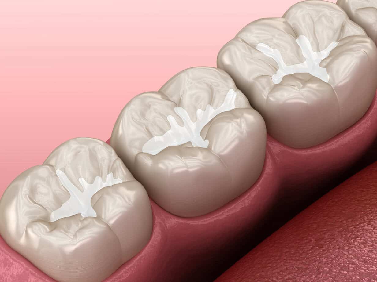 Digital illustration shows molar teeth with tooth-colored dental sealants. The surface of the teeth is covered by sealant products, appearing as white, plastic-like material filling the grooves and pits to prevent cavities. The gums are pink and healthy.